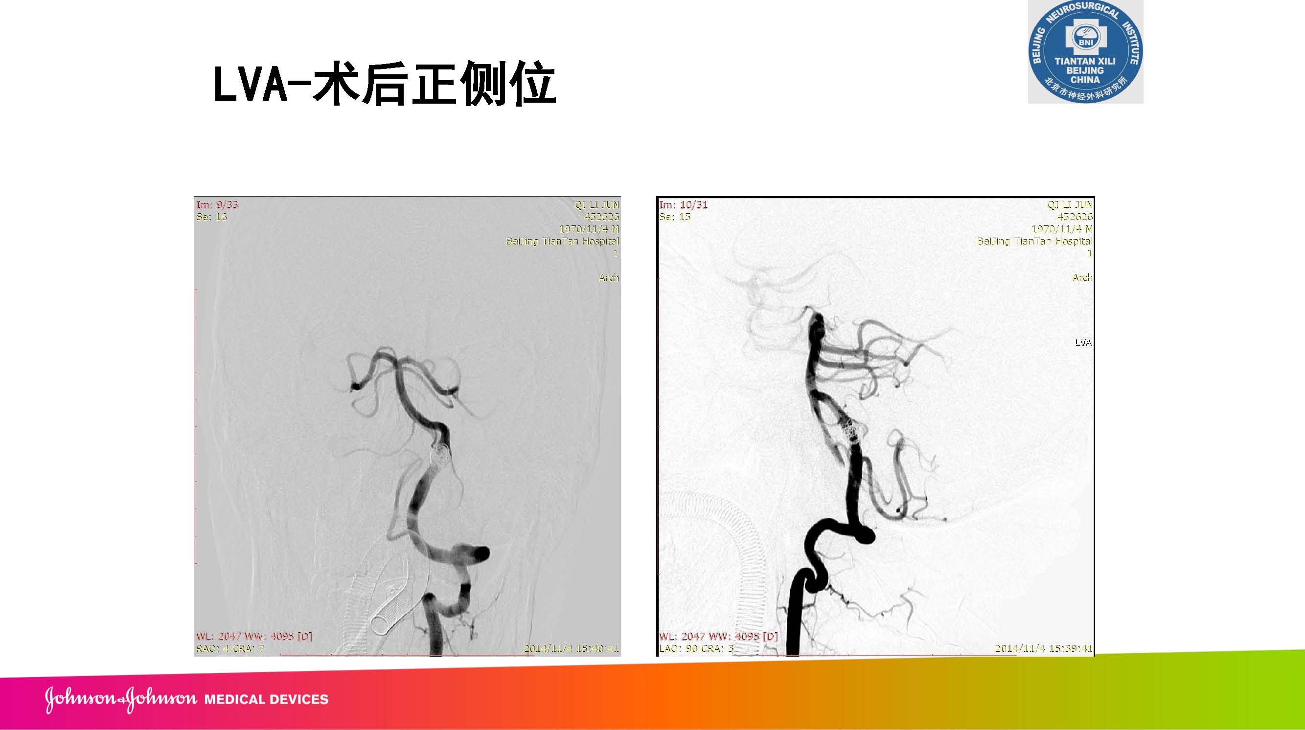 支架结合弹簧圈治疗椎动脉夹层一例(穆斯卿）_页面_15.jpg