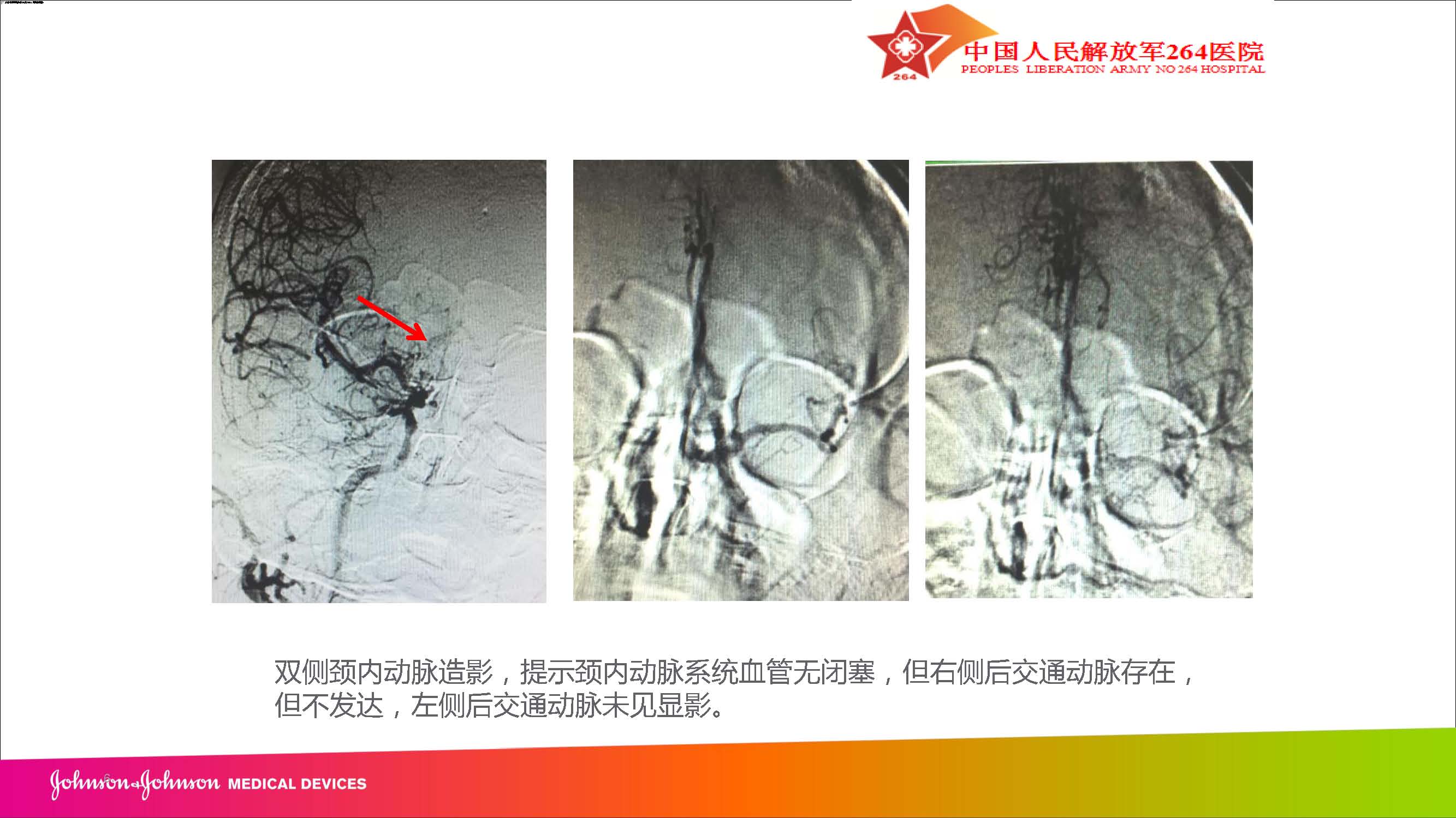 2018-4-13Revive SE取栓病例汇报（朱青峰）_页面_06.jpg