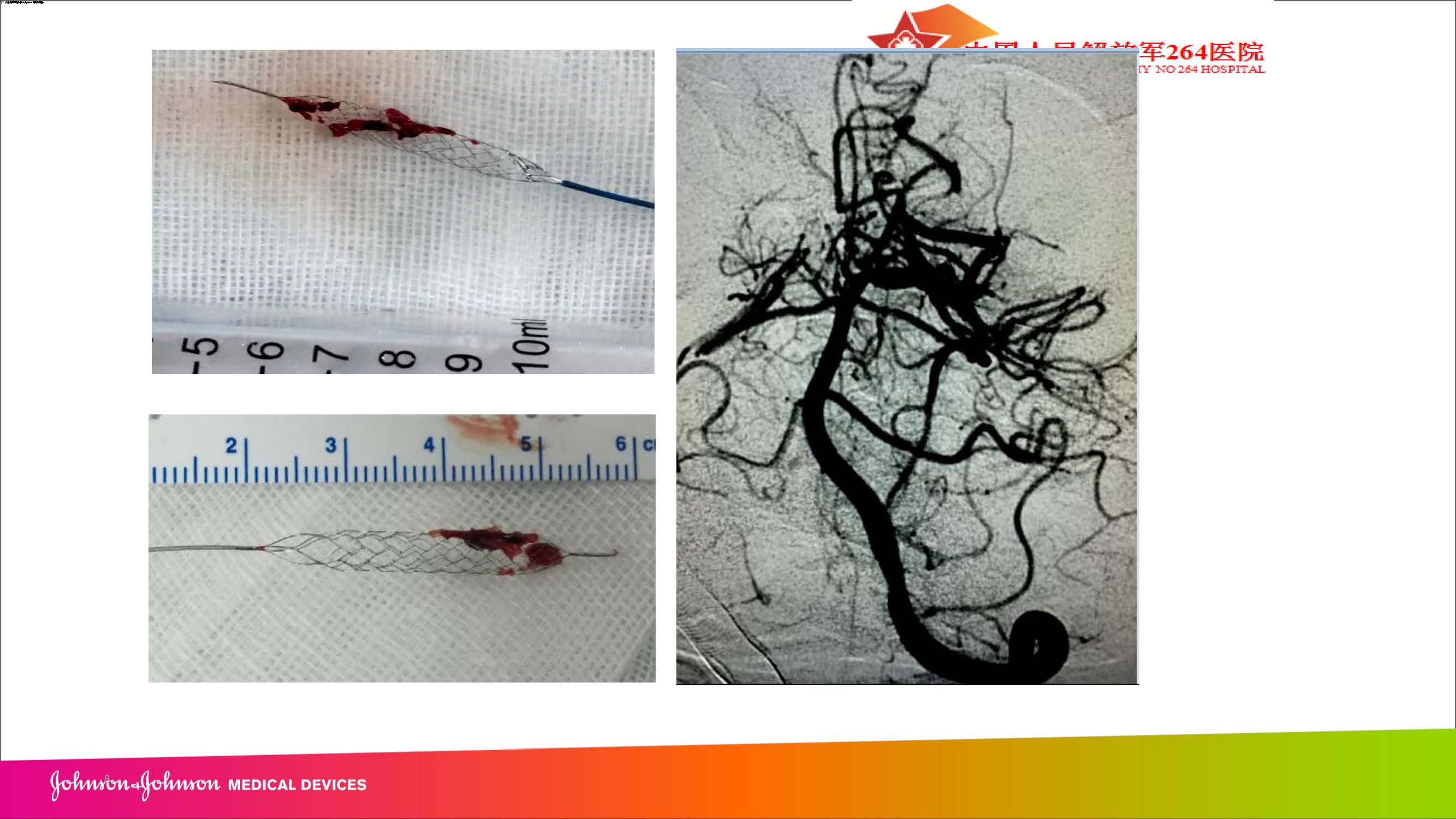2018-4-13Revive SE取栓病例汇报（朱青峰）_页面_08.jpg