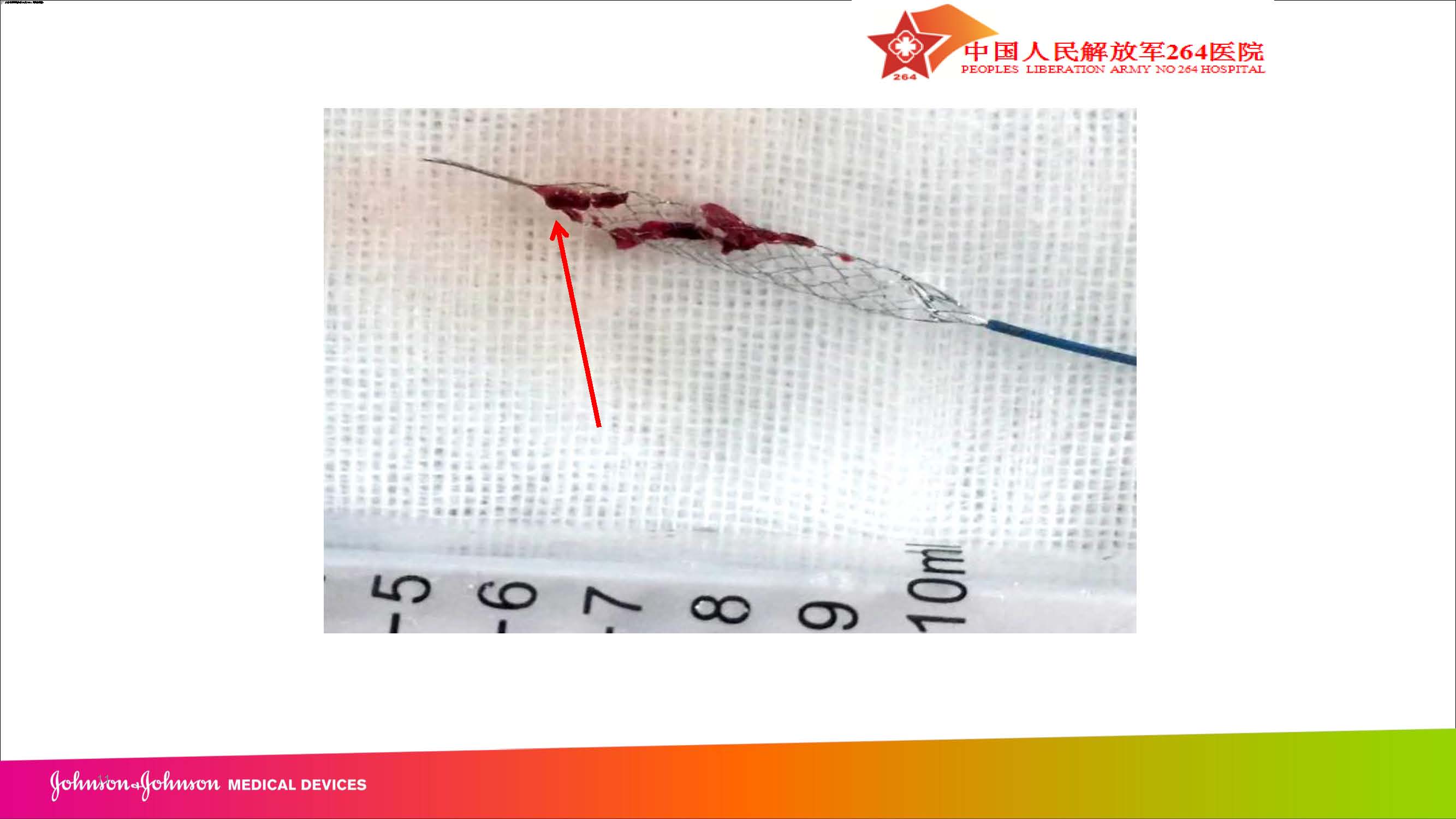 2018-4-13Revive SE取栓病例汇报（朱青峰）_页面_11.jpg