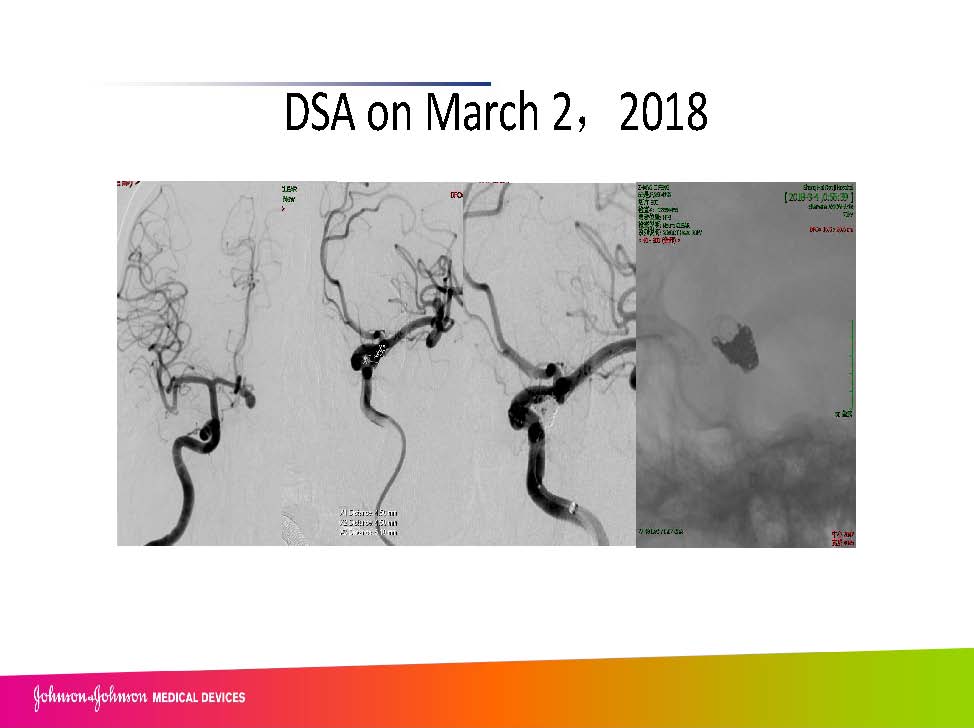 0413 赵兵AcoA 栓塞_页面_04.jpg