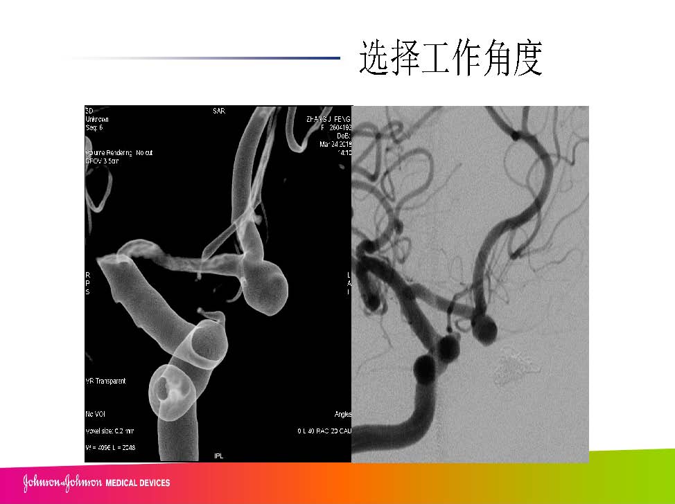 0413 赵兵AcoA 栓塞_页面_10.jpg