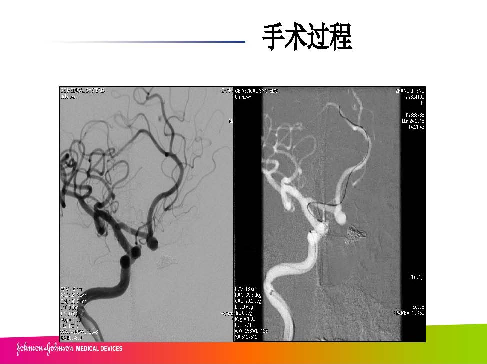 0413 赵兵AcoA 栓塞_页面_12.jpg