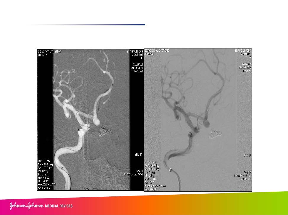 0413 赵兵AcoA 栓塞_页面_13.jpg