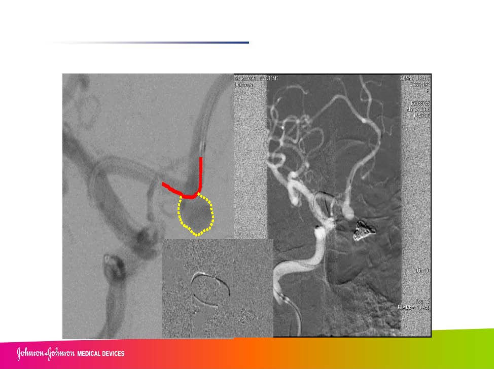 0413 赵兵AcoA 栓塞_页面_14.jpg