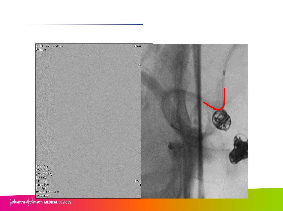 0413 赵兵AcoA 栓塞_页面_15.jpg