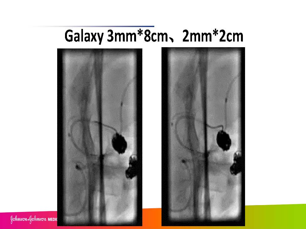 0413 赵兵AcoA 栓塞_页面_16.jpg