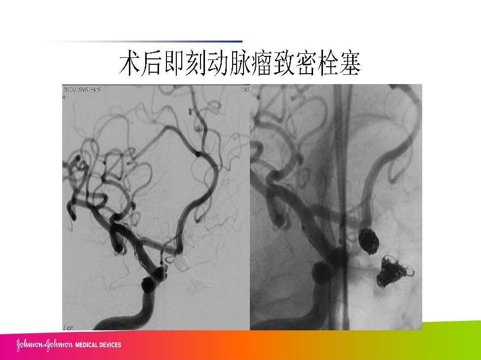 0413 赵兵AcoA 栓塞_页面_17.jpg
