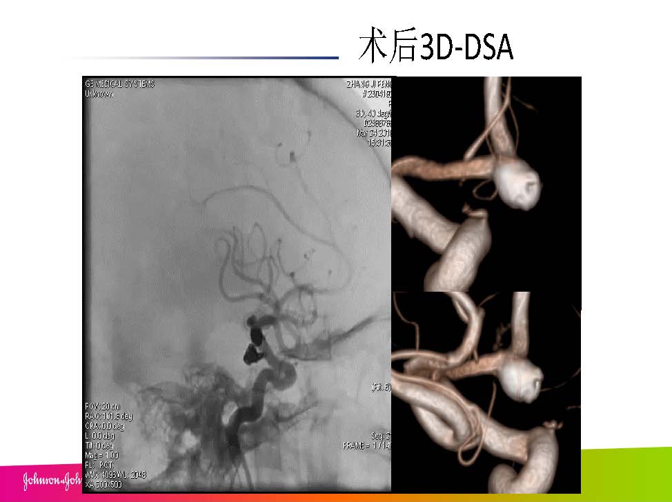 0413 赵兵AcoA 栓塞_页面_18.jpg